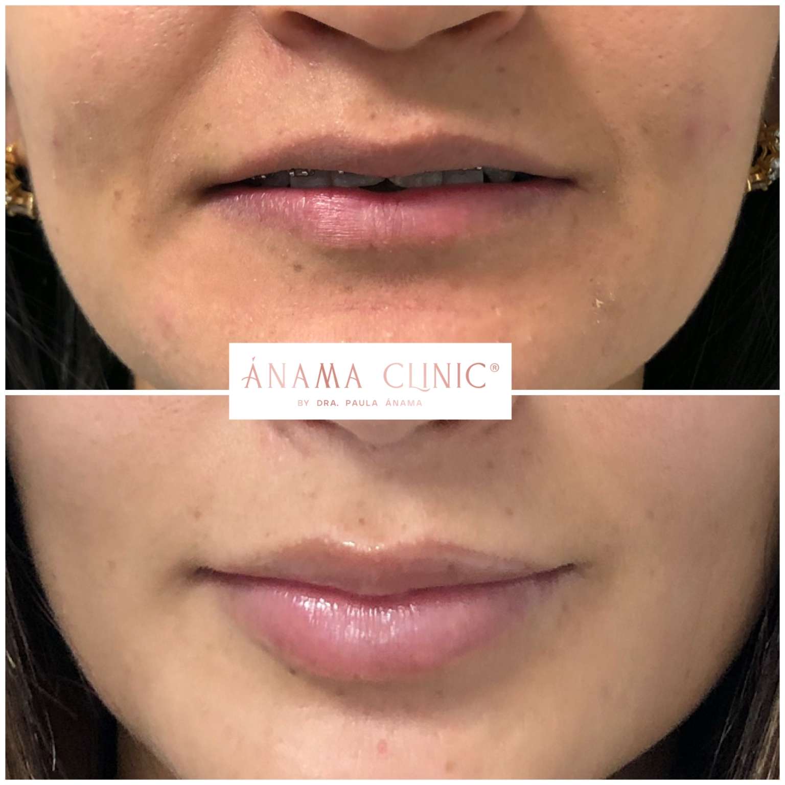 Antes y Después
