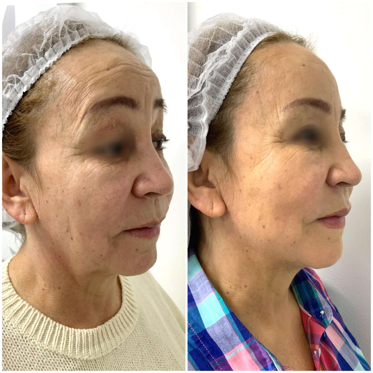 Antes y Después