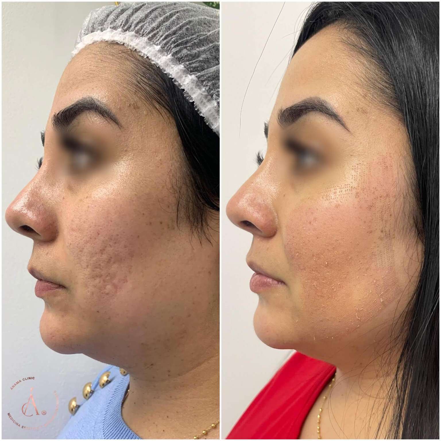 Antes y Después