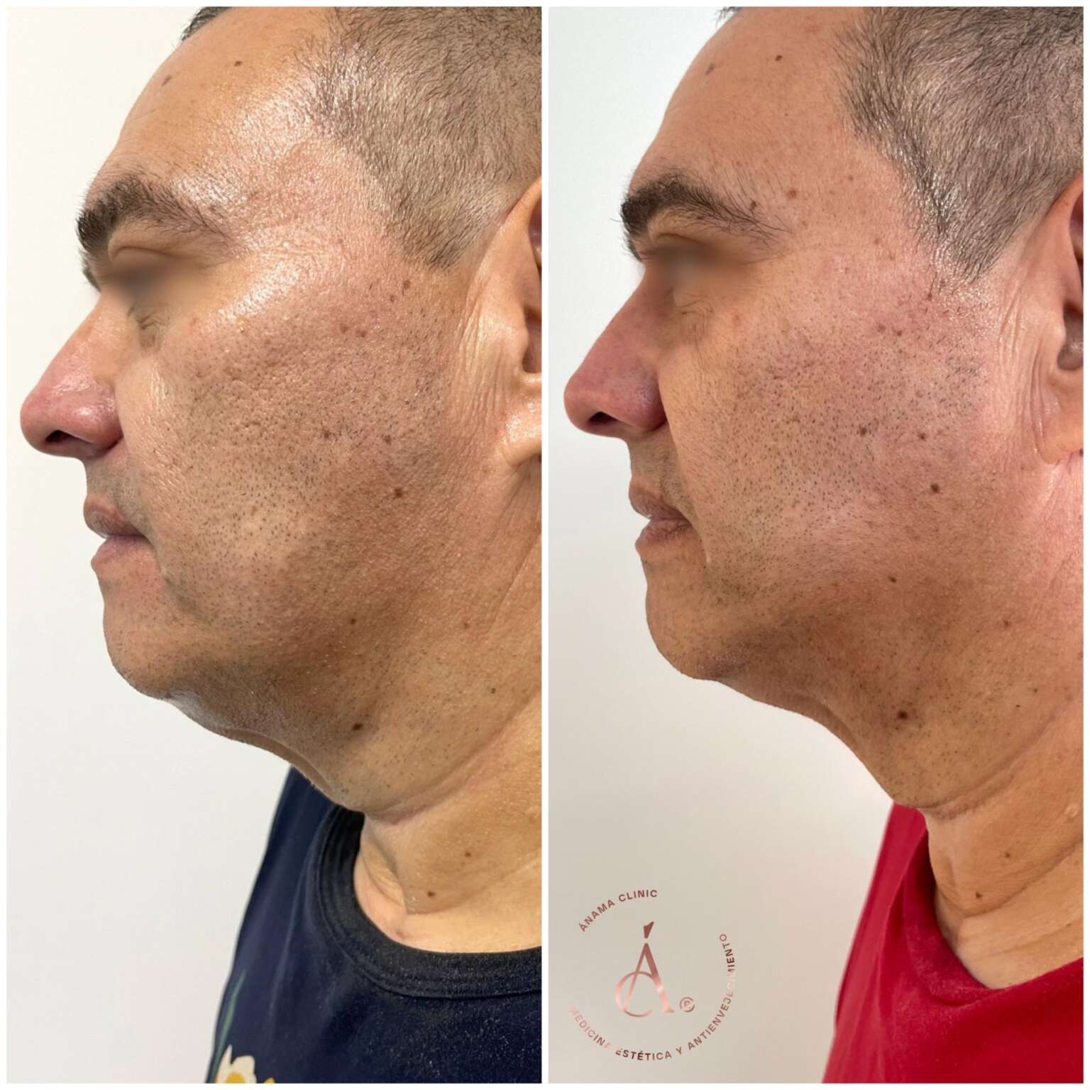 Antes y Después