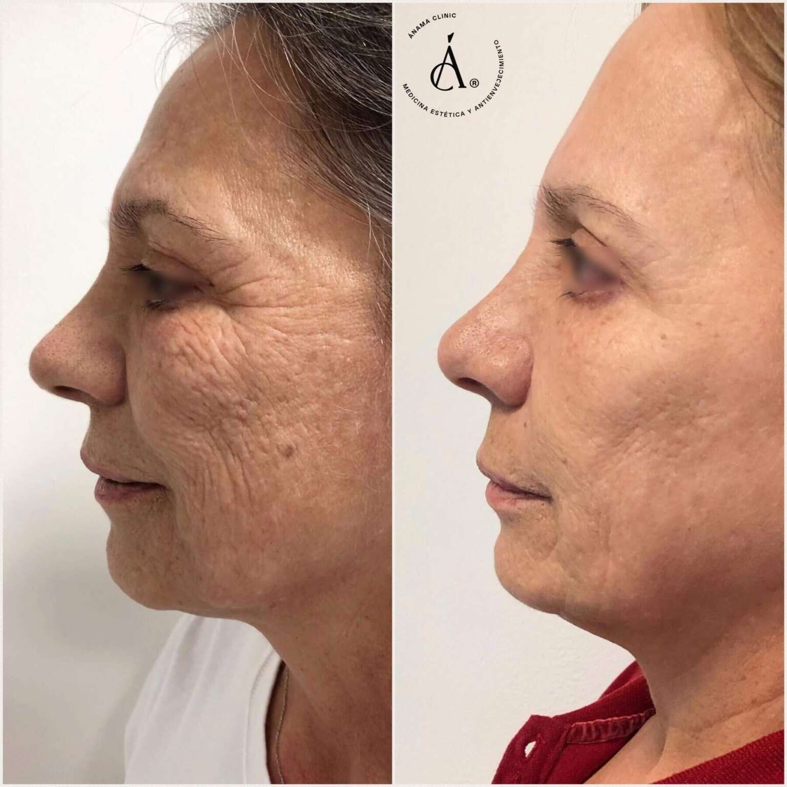 Antes y Después